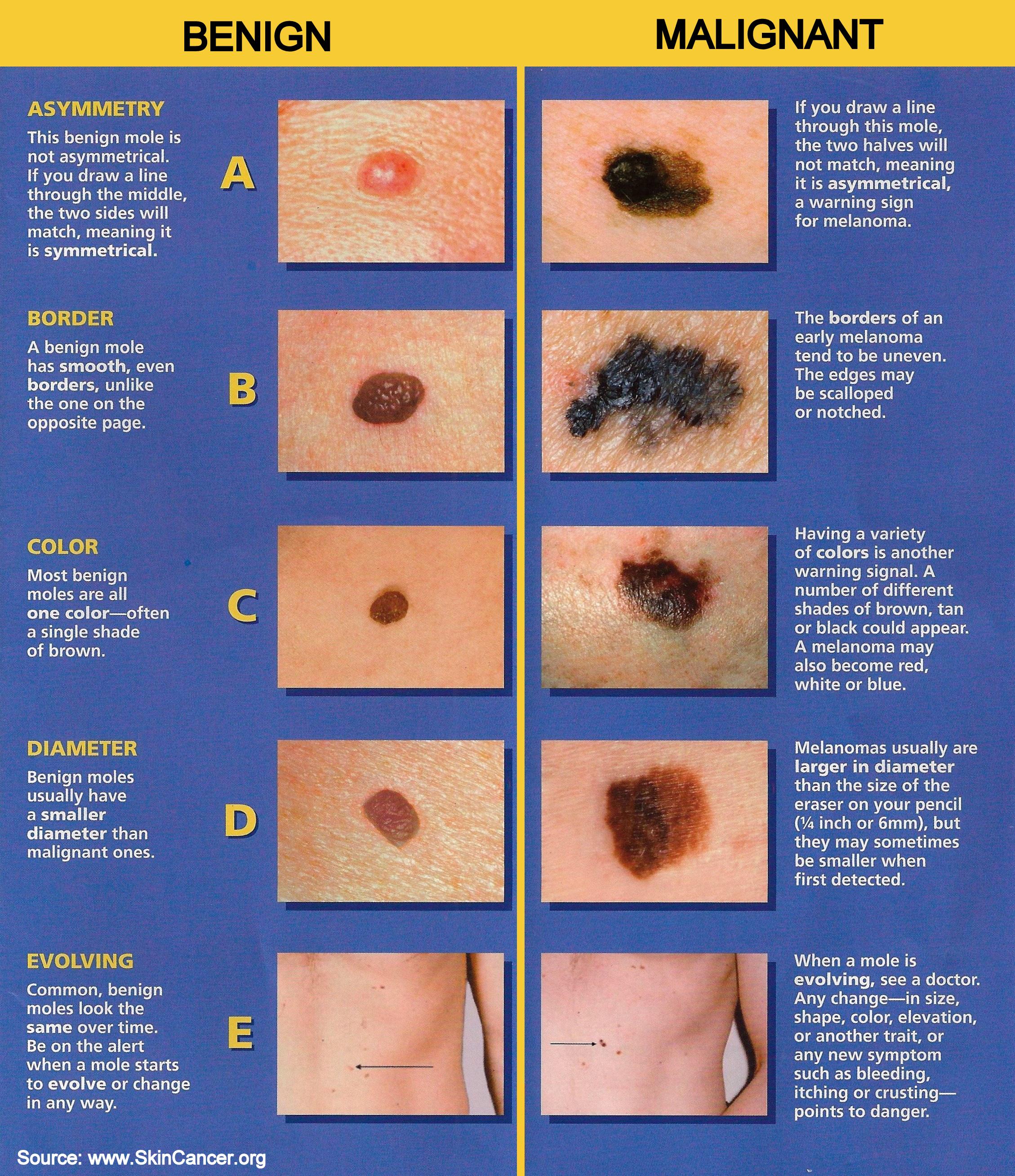 skin cancer chart